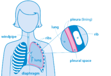 Cancer Symptoms and Treatments